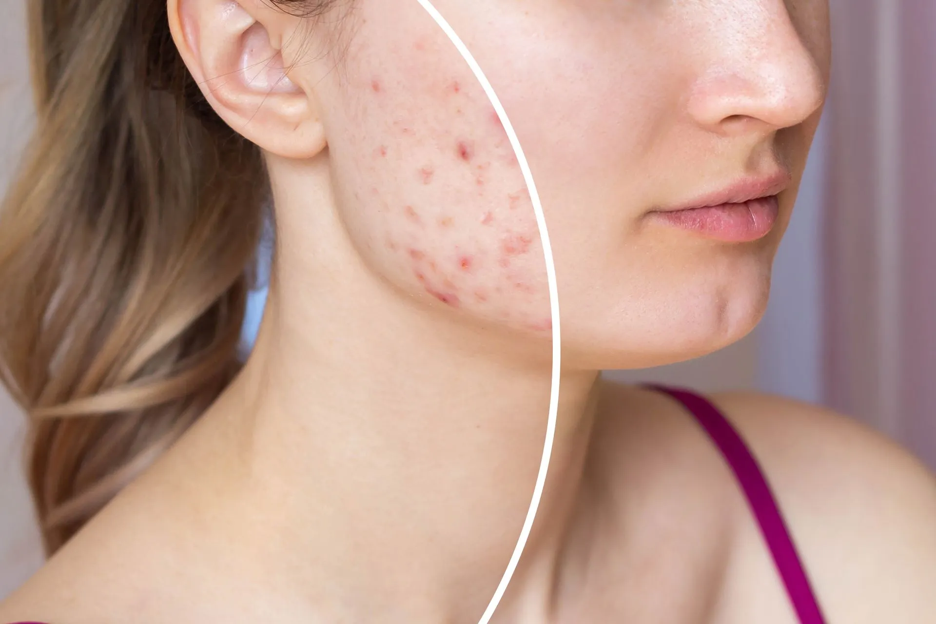A woman receiving Erase Acne Scars: PRX Biostimulator Treatments in La Jolla, CA at Brandish Clinic Facial and Skin Rejuvenation.