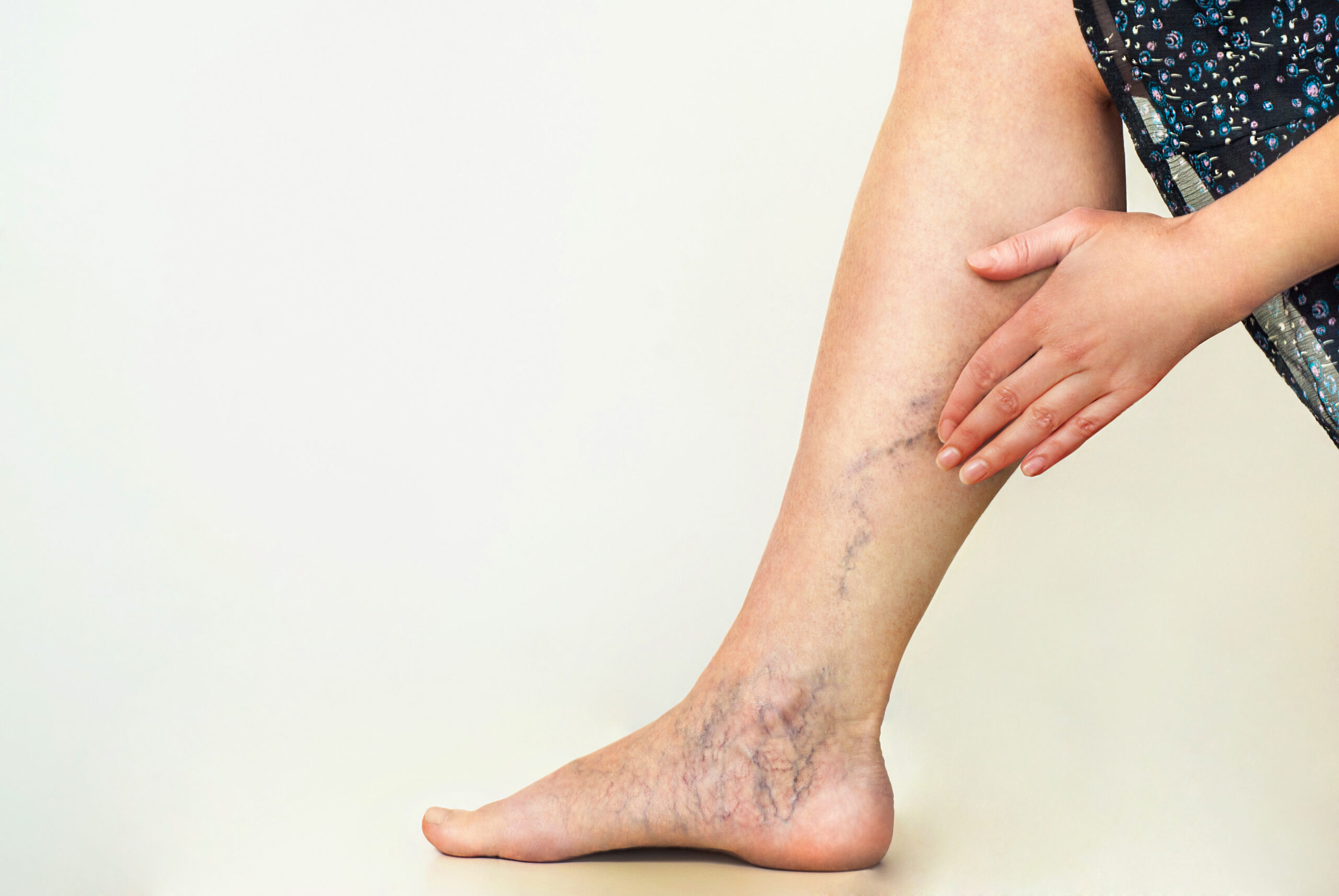 Varicose veins on the womans legs to treat with Vascular Treatments in La Jolla, CA at Brandish Clinic Facial and Skin Rejuvenation